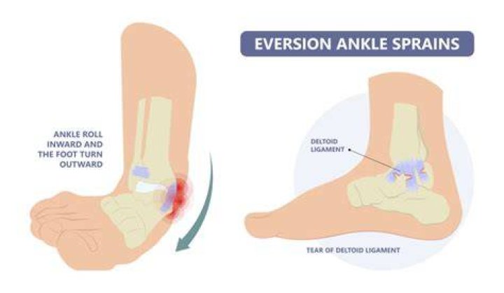 Deltoid Ligament Sprain How to Treat a Sprain of the Deltoid Ligament