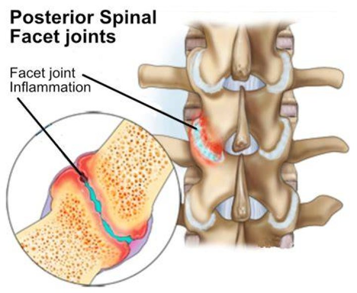 Facet Arthropathy What Is It, Causes, Signs and Symptoms, and More
