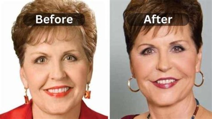 Joyce Meyer's Facial Surgery: A Transformation Revealed