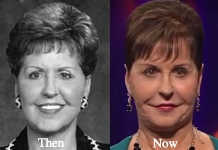 Joyce Meyer's Plastic Surgery: Before And After Transformation