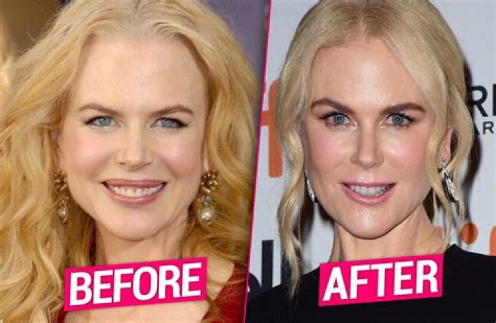 nicole kidman Botched Plastic Surgery, Bad Plastic Surgeries, Plastic