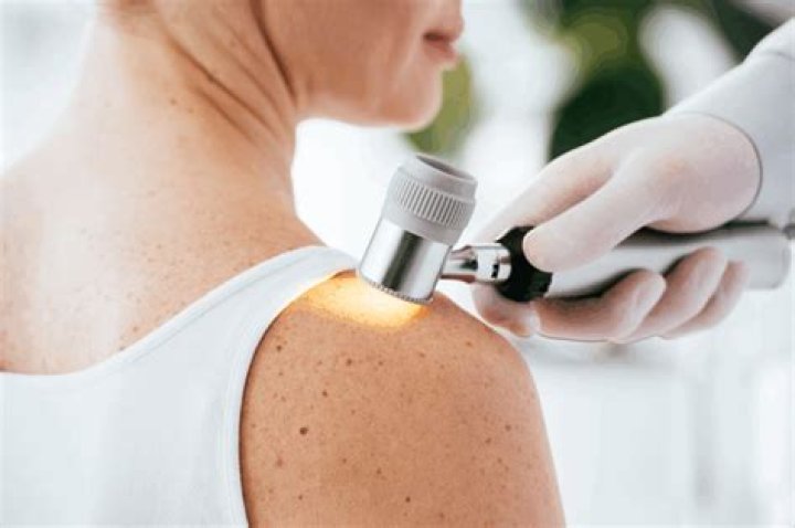 Pitir&iacute;ase r&oacute;sea Dermatologia