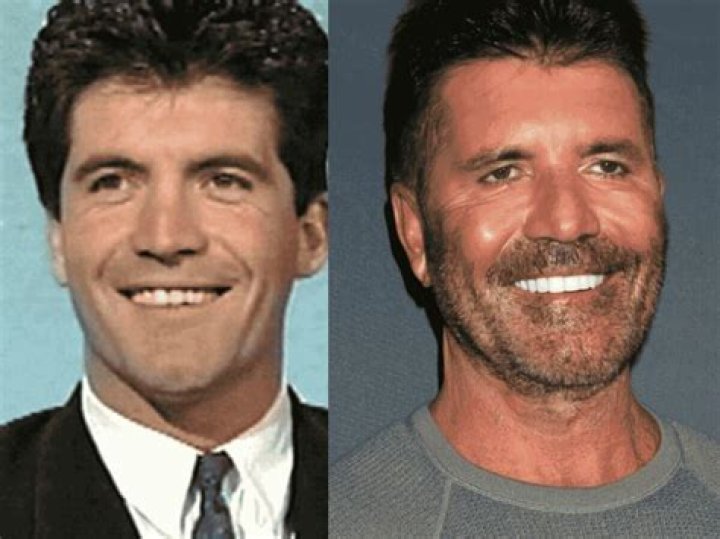 Simon Cowell lost a tooth the same week as recent bike accident